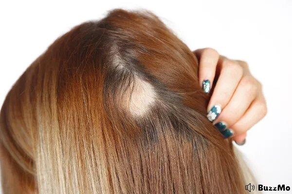 Alopecia Areata: What it is, causes, symptoms and treatments