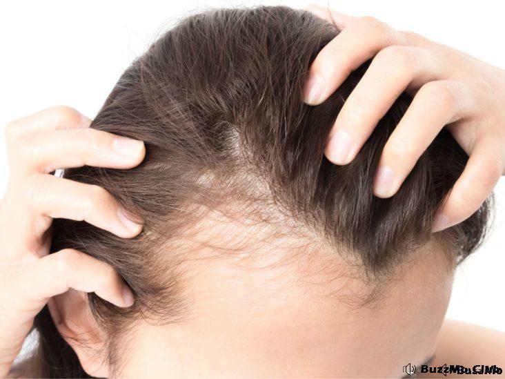 Hair Loss (Alopecia) Prevention and Treatment for Women