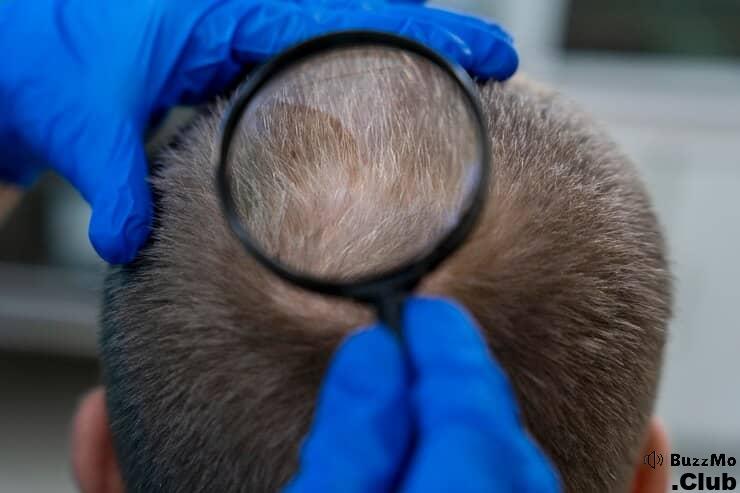 Preventing Alopecia Areata Spread